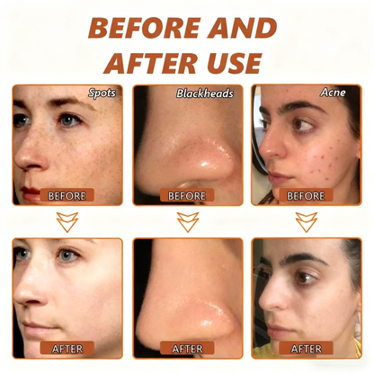 Blemish Skin Whitening Lightening Spot Mask Freckle👩‍⚕️